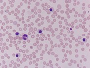 RhD Hemolytic disease of newborn