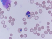 hemolytic disease of the newborn blood smear