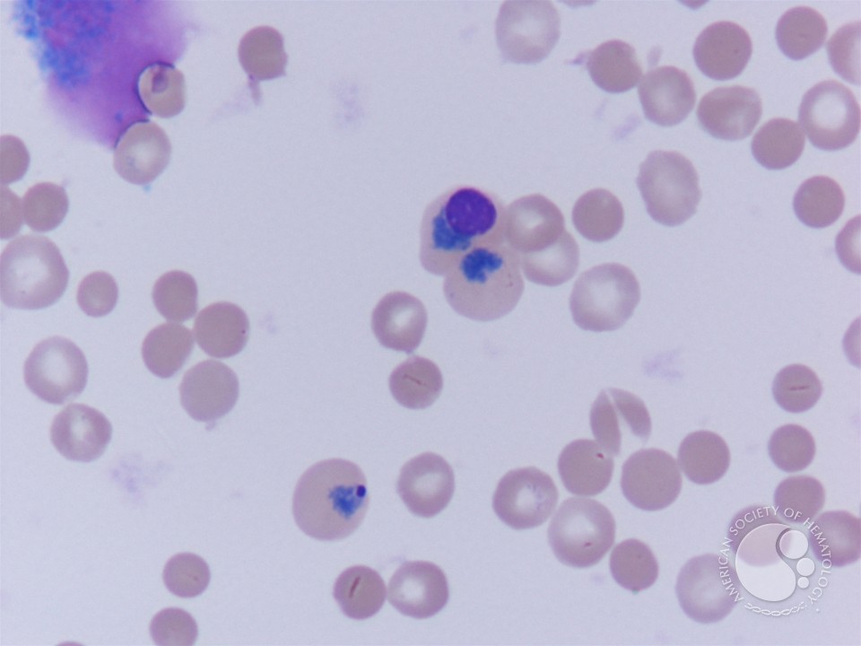 RhD Hemolytic disease of newborn