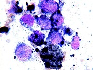 Metastatic malignant melanoma in bone marrow