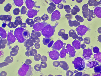 AML Blast with Hemophagocytosis