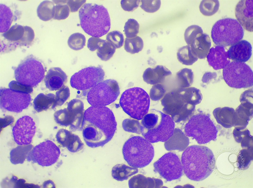 AML Blast with Hemophagocytosis