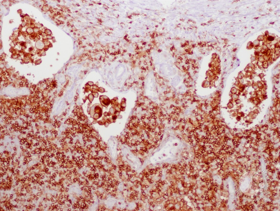CD163 positive atypical histiocytes