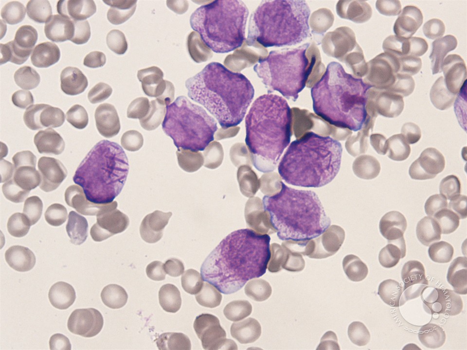 Promyelocytes with Auer rods - 02