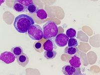 Acute myeloid leukemia with myelodysplasia related changes 1