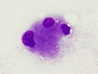 Acute myeloid leukemia with myelodysplasia related changes 3