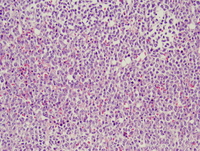 Mixed phenotype acute leukemia with t(9;22)(q34;q211.2); BCR-ABL Bone Marrow  Biopsy