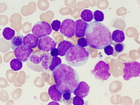 Mixed phenotype acute leukemia with t(9;22)(q34;q211.2); BCR-ABL Aspirate