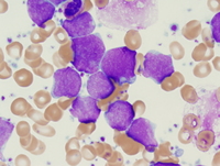 Acute undifferentiated leukemia Bone Marrow high power