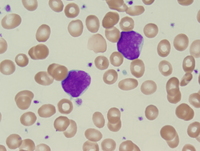 Acute undifferentiated leukemia-Peripheral Blood