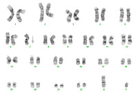 Acute myeloid leukemia with myelodysplasia related changes