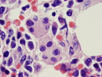 Acute myeloid leukemia with myelodysplasia related changes-Biopsy