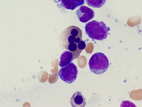 Acute myeloid leukemia with myelodysplasia related changes-aspirate