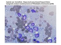 ALL Ph+ CD 13 positive Aspirate