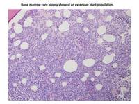 ALL Ph+ CD 13 positive biopsy