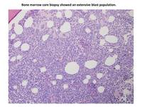 ALL Ph+ CD 13 positive biopsy