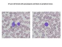 ALL Ph+ CD 13 positive peripheral blood