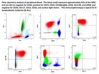B cell ALL flow cytometry