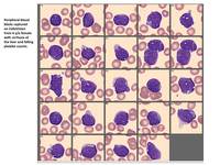 B cell ALL peripheral blood