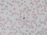 Congenital sideroblastic anemia peripheral blood