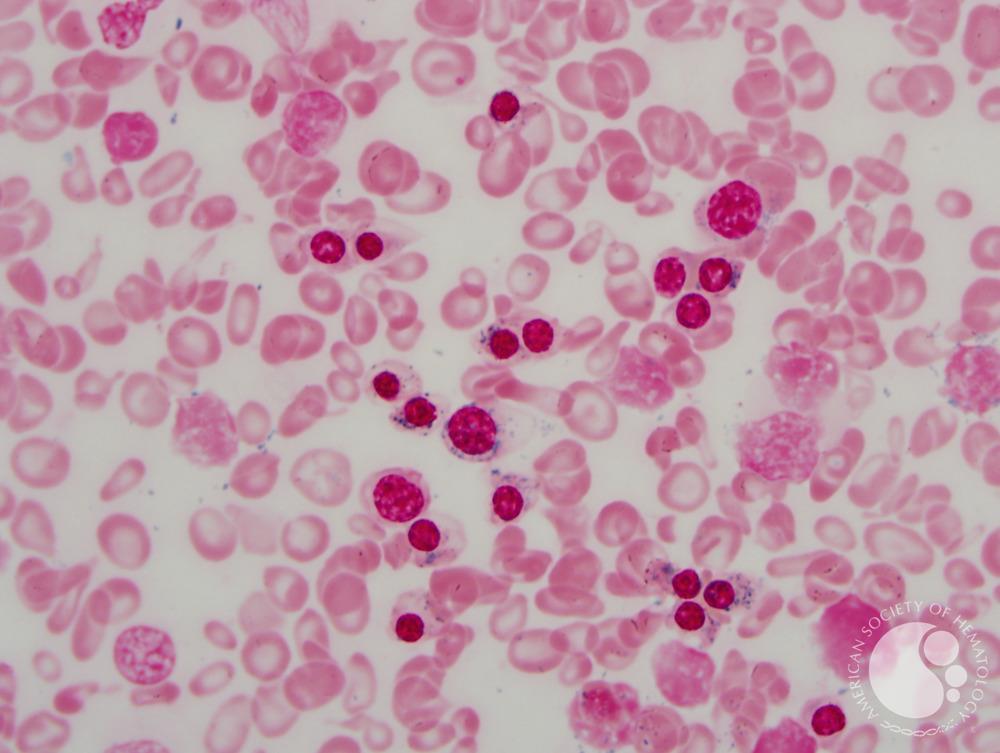 Congenital sideroblastic anemia iron stain