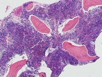 Congenital Sideroblastic Anemia Biopsy