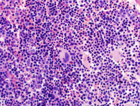 Congenital sideroblastic anemia biopsy