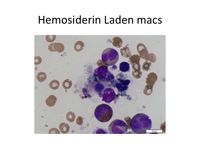 macrophage with hemosiderin