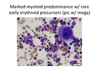 Diamond Blackfan Anemia Marrow Aspirate