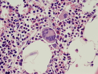 Essential thrombocythemia