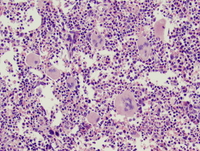 Essential thrombocythemia