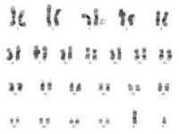 AML with inv(3)(q21q26.2) cytogenetics