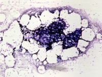 Dyskeratosis Congenita