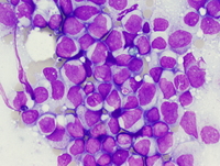 Therapyrelated myeloid neoplasm (Acute myeloid leukemia)