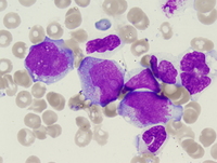 Therapy-related myeloid neoplasm (Acute myeloid leukemia)