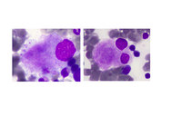 Emberger syndrome dysplastic megakaryocytes