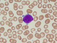 Myeloid leukemia associated with Down syndrome 1