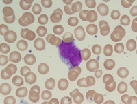 Myeloid leukemia associated with Down syndrome 2