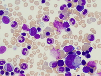 Myeloid leukemia associated with Down syndrome 3