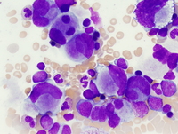 Myeloid leukemia associated with Down syndrome 4