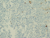 Myeloid leukemia associated with Down syndrome 5