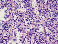 Myeloid leukemia associated with Down syndrome 7