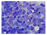 T-cell-ALL-Biopsy