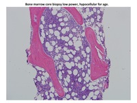 T-cell-ALL-Marrow-Biopsy