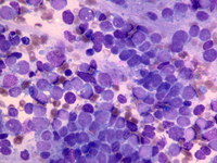 Neuroblastoma bone marrow