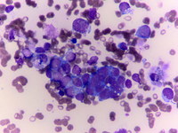 Neuroblastoma bone marrow