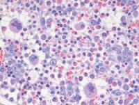 Hematolymphoid neoplasm with PDGFRA rearrangement 3