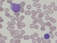 Mixed phenotype acute leukemia 1