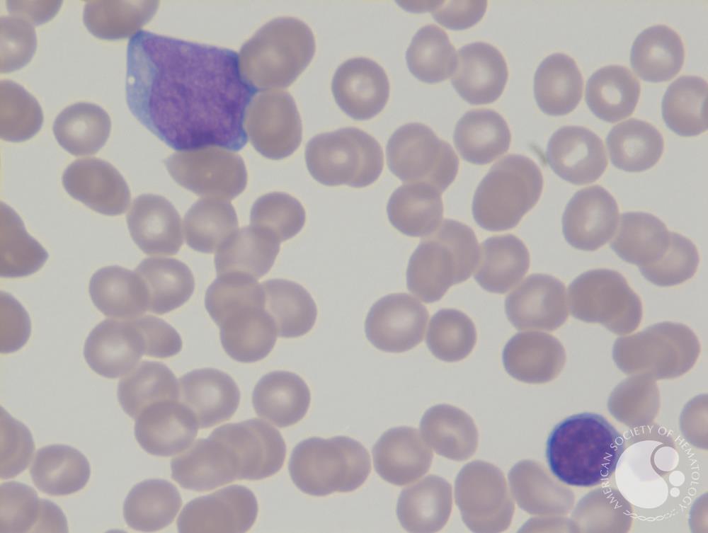 Mixed phenotype acute leukemia 1