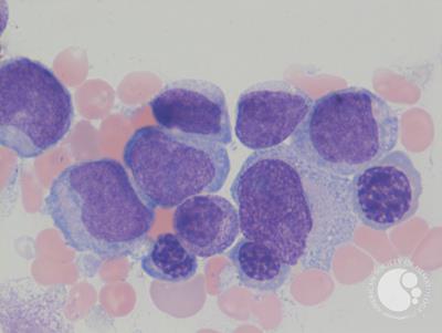 Mixed phenotype acute leukemia 2